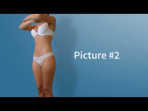 How to take photos for Liposuction (Lipo) and Brazilian Butt Lift (BBL) online consultation