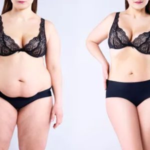 Tummy Tuck Miami