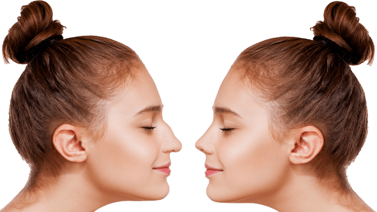 Rhinoplasty Miami