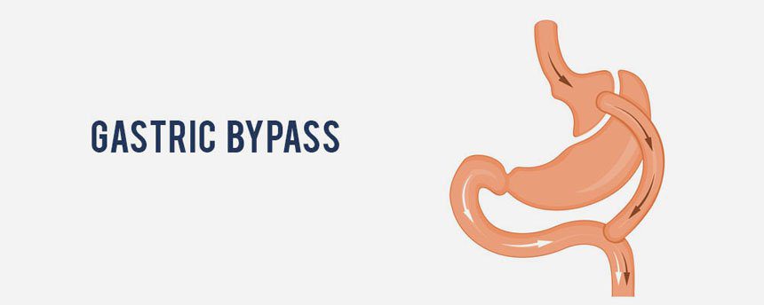 Gastric Bypass Surgery in Miami