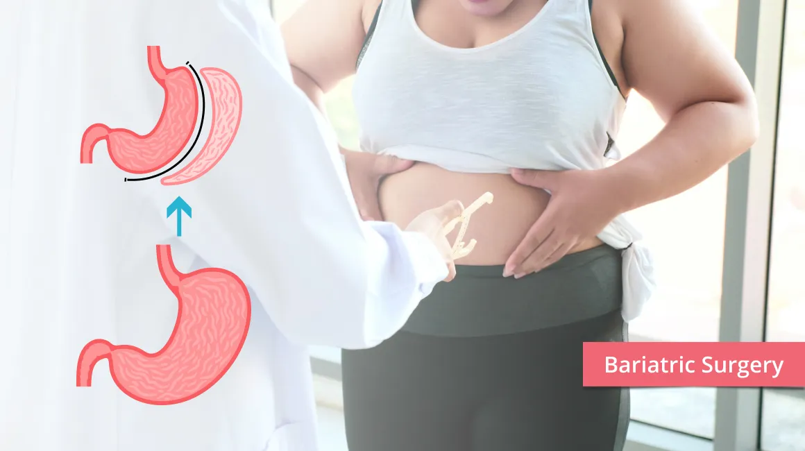 Bariatric Gastric Sleeve Surgery Weight Loss Miami