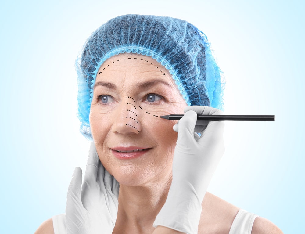 Blepharoplasty consultation and eyelid marking in Miami