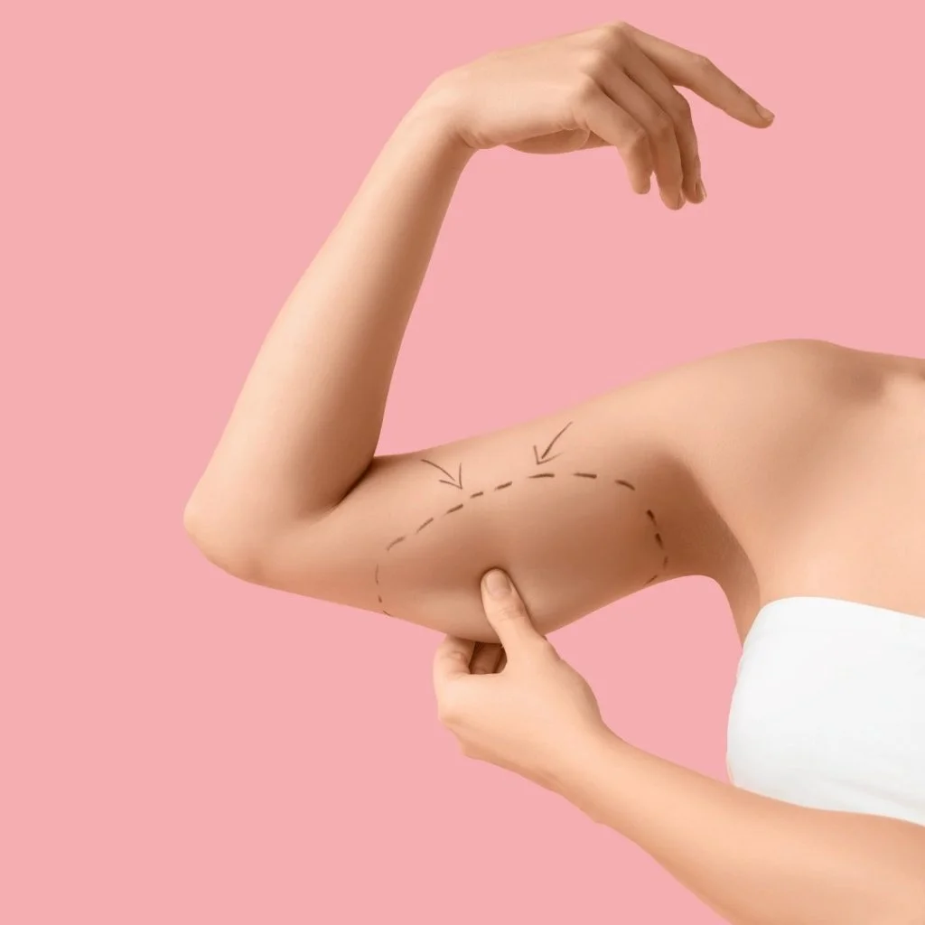 Arm Lift Miami Contouring Results
