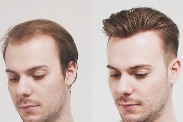 FUE Hair Transplant Restoration Miami Florida
