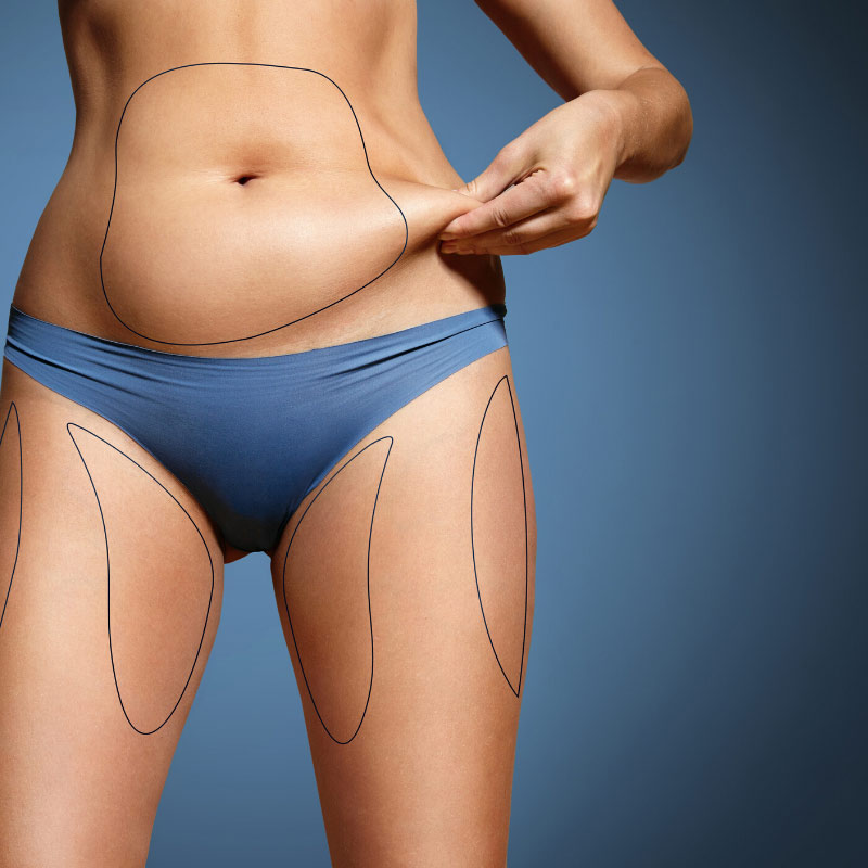 J-Plasma Renuvion Skin Tightening Procedure Miami