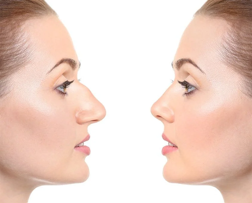 Rhinoplasty Nose Job Surgery Specialist Miami